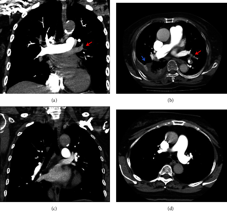 Prognostic Risk Factors of 30-Day Death in Traumatic Lower Limb Fracture Patients with Acute Pulmonary Embolism: A Single-Center Retrospective Study.