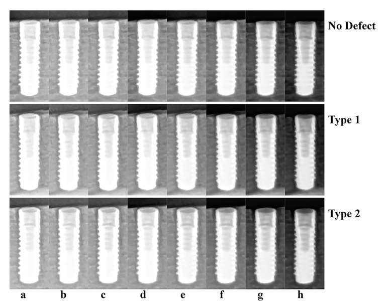 Evaluation of the different exposure parameters for the accurate diagnosis of peri-implantitis severity in digital panoramic radiography.