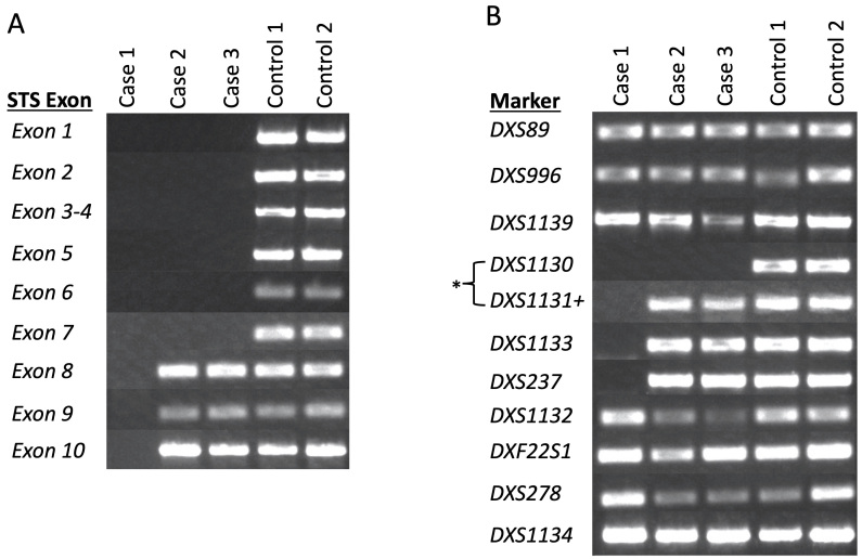 Identification of a novel partial deletion of <i>STS</i> associated with pre-Descemet corneal dystrophy and X-linked ichthyosis.