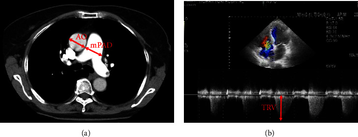 Prognostic Risk Factors of 30-Day Death in Traumatic Lower Limb Fracture Patients with Acute Pulmonary Embolism: A Single-Center Retrospective Study.