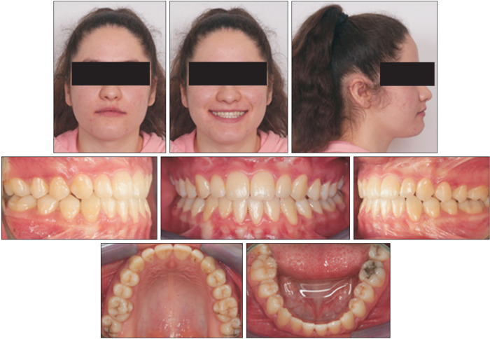 Correction of late adolescent skeletal Class III using the Alt-RAMEC protocol and skeletal anchorage.