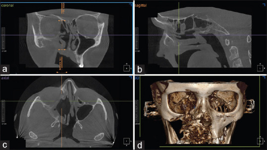 A New Diagnostic Criteria and Grading System of Rhino-Maxillary Mucormycosis based on Cone Beam Computed Tomographic Findings.