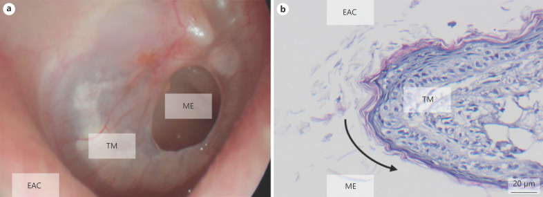 The Dorsal Skinfold Chamber as a New Tympanic Membrane Wound Healing Model: Intravital Insights into the Pathophysiology of Epithelialized Wounds.