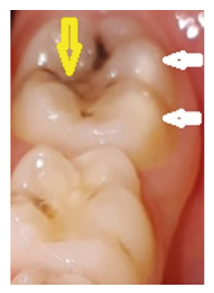 Assessment of oral manifestations in pediatric patients with celiac disease in relation to marsh types.