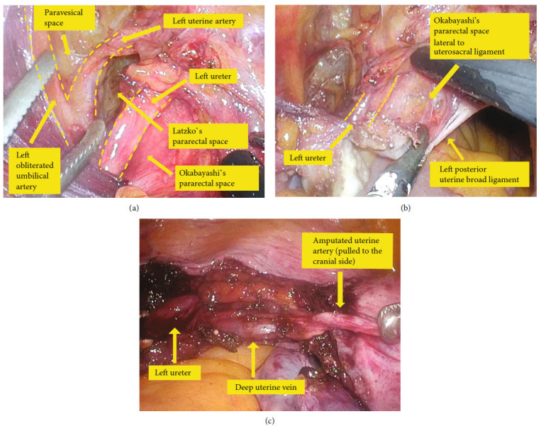 Ureter Injury in Total Laparoscopic Hysterectomy.