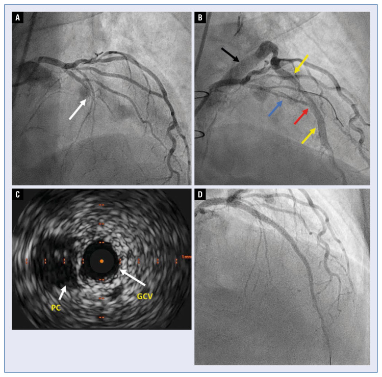 Left-anterior descending chronic total occlusion percutaneous coronary intervention complicated by great cardiac vein fistula: An unusual route for intravascular ultrasound guided successful recanalization.