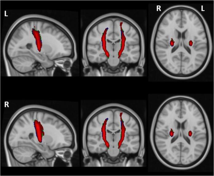 Aberrant corticospinal tract characteristics in prodromal PD: A diffusion tensor imaging study