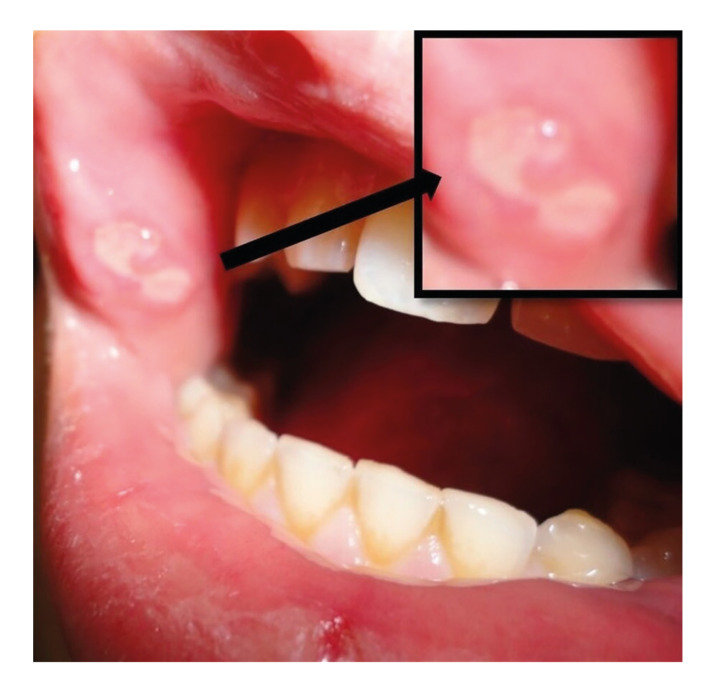 Assessment of oral manifestations in pediatric patients with celiac disease in relation to marsh types.