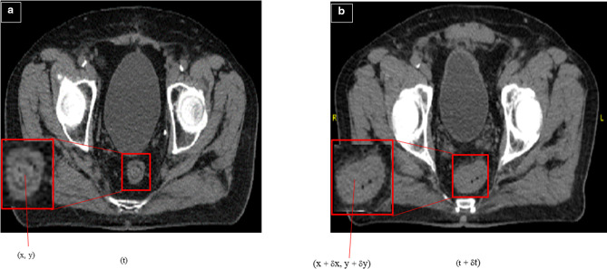 The geometric and dosimetric accuracy of kilovoltage cone beam computed tomography images for adaptive treatment: a systematic review.