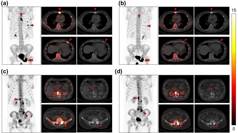 Quantification of bone metabolic activity in the natural course of fractural lesions measured by quantitative SPECT/CT.