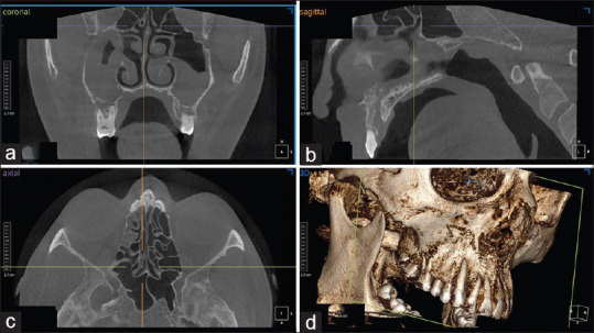 A New Diagnostic Criteria and Grading System of Rhino-Maxillary Mucormycosis based on Cone Beam Computed Tomographic Findings.