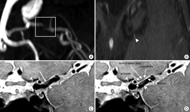 Wall Shear Stress Associated with Stroke Occurrence and Mechanisms in Middle Cerebral Artery Atherosclerosis.