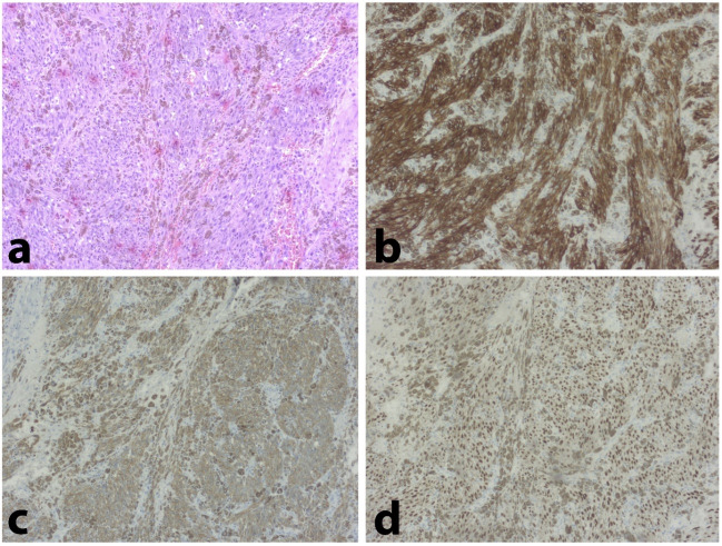 Melanoma Originating from the Dura-Mater: A Case Report and Review of the Literature.