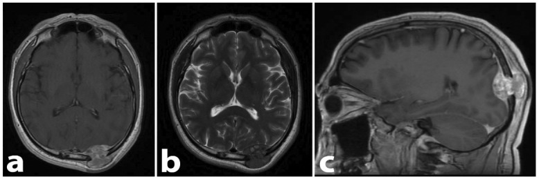 Melanoma Originating from the Dura-Mater: A Case Report and Review of the Literature.