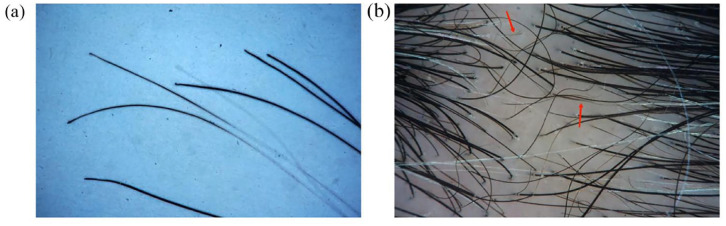 Hair repigmentation and regrowth in a dupilumab-treated paediatric patient with alopecia areata and atopic dermatitis: a case report.