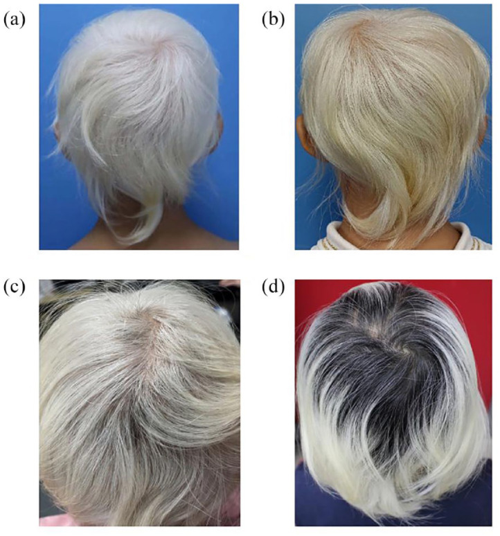 Hair repigmentation and regrowth in a dupilumab-treated paediatric patient with alopecia areata and atopic dermatitis: a case report.