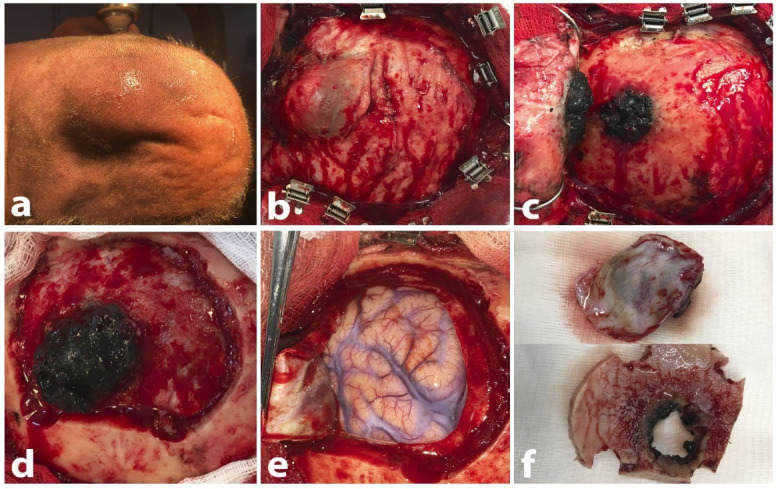 Melanoma Originating from the Dura-Mater: A Case Report and Review of the Literature.