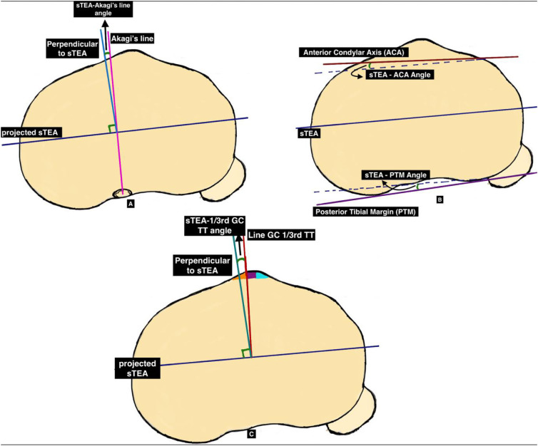 A computed tomographic evaluation of femoral and tibial rotational reference axes in total knee arthroplasty.