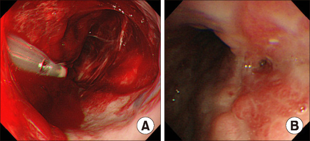 Esophageal Rupture Due to Unexpected Sengstaken-Blakemore Tube Placement.