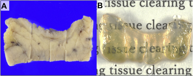 Three-dimensional analysis of perineural invasion in extrahepatic cholangiocarcinoma using tissue clearing.