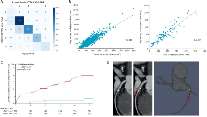 Artificial intelligence in cardiovascular imaging: enhancing image analysis and risk stratification.