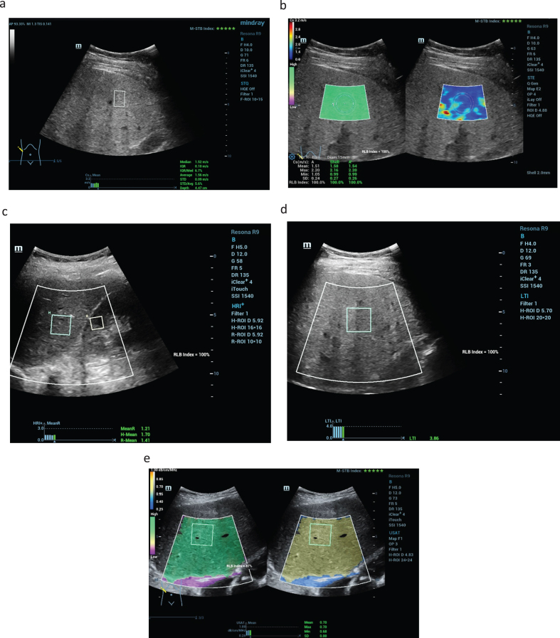 Current aspects of multimodal ultrasound liver diagnostics using contrast-enhanced ultrasonography (CEUS), fat evaluation, fibrosis assessment, and perfusion analysis - An update.