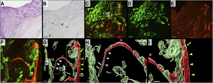 Three-dimensional analysis of perineural invasion in extrahepatic cholangiocarcinoma using tissue clearing.