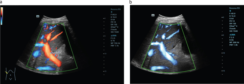 Current aspects of multimodal ultrasound liver diagnostics using contrast-enhanced ultrasonography (CEUS), fat evaluation, fibrosis assessment, and perfusion analysis - An update.