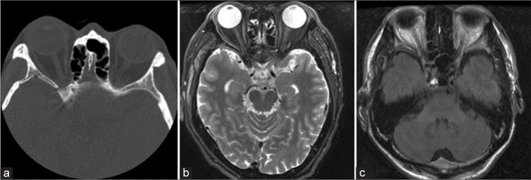 Visual-evoked potential predicts the efficacy of the optical canal decompression for traumatic optic nerve neuropathy showing blindness: A case report.