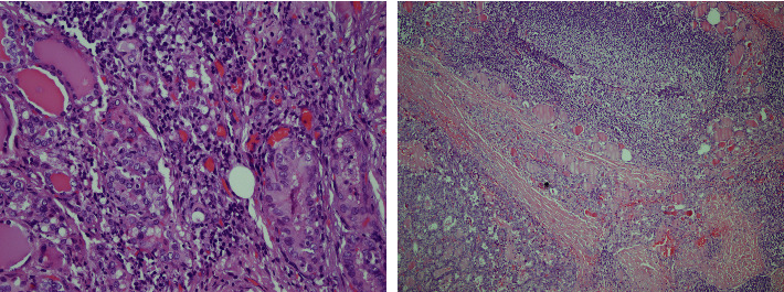 Incidental Papillary Microcarcinoma and Papillary Thyroid Carcinoma in Multinodular Goiter.