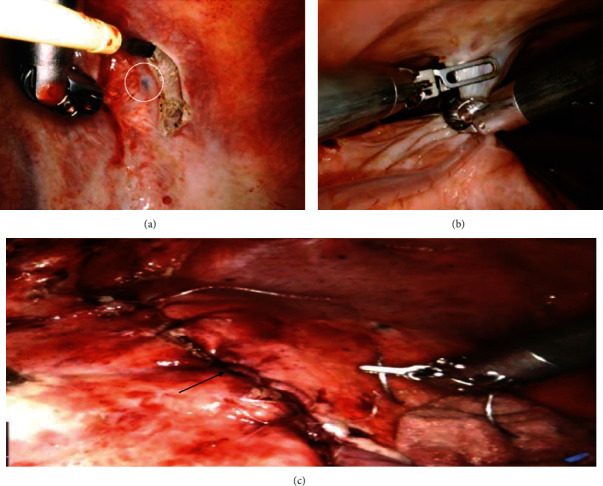 Robotic-Assisted Thoracic Surgery Approach to Thoracic Endometriosis Syndrome with Unilateral Diaphragmatic Palsy.