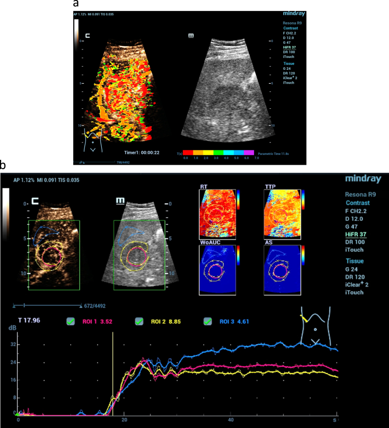 Current aspects of multimodal ultrasound liver diagnostics using contrast-enhanced ultrasonography (CEUS), fat evaluation, fibrosis assessment, and perfusion analysis - An update.