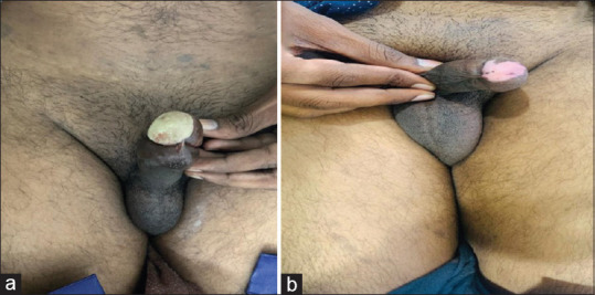 Pseudoepitheliomatous keratotic and micaceous balanitis: A distinct entity.