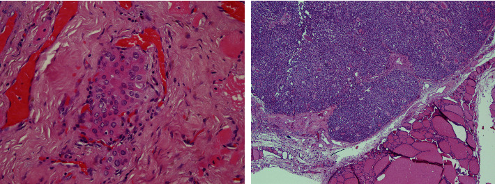 Incidental Papillary Microcarcinoma and Papillary Thyroid Carcinoma in Multinodular Goiter.