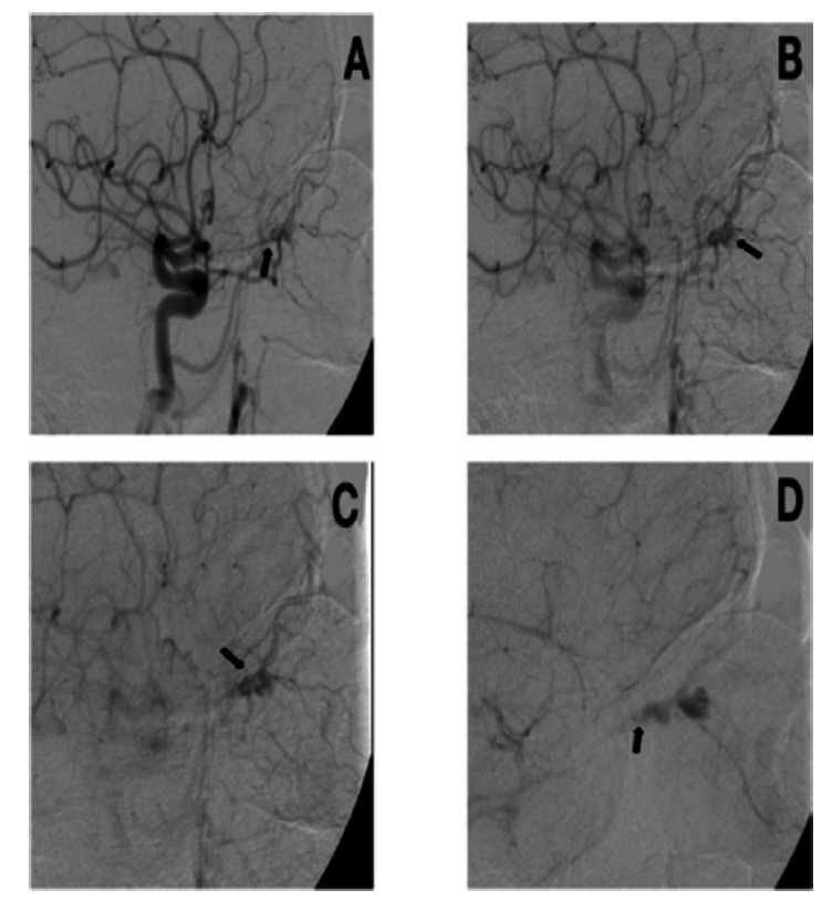 Thrombosis of intraorbital arterio-venous fistula.