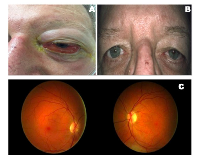 Thrombosis of intraorbital arterio-venous fistula.