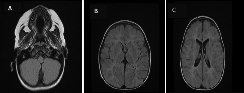 Identification of a de novo Mutation in TMEM106B in a Saudi Child Causes Hypomyelination Leukodystrophy.