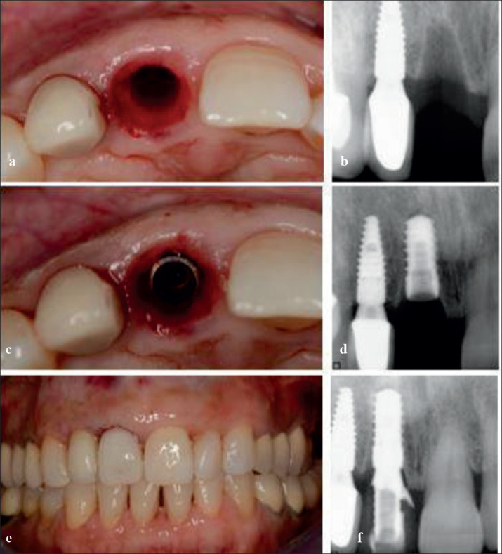 Single Immediate Implant Placement with Provisional Crown in the Esthetic Zone with 6 Years Follow-Up.