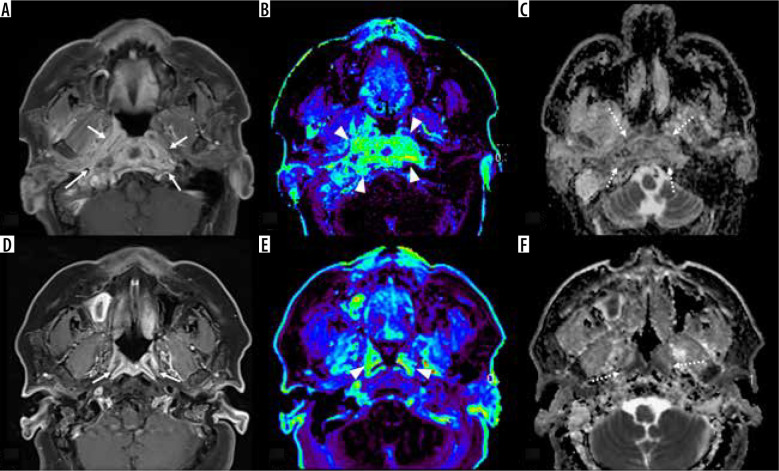 Dynamic contrast-enhanced MRI parameters and apparent diffusion coefficient as treatment response markers of skull base osteomyelitis: a preliminary study.