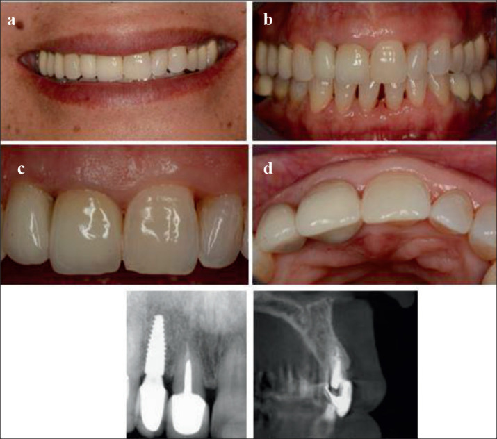 Single Immediate Implant Placement with Provisional Crown in the Esthetic Zone with 6 Years Follow-Up.