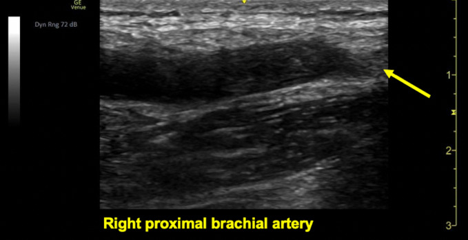 Acute Upper Extremity Arterial Occlusion Diagnosed on POCUS in the Emergency Department.