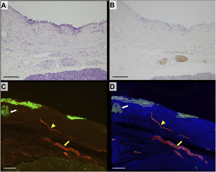 Three-dimensional analysis of perineural invasion in extrahepatic cholangiocarcinoma using tissue clearing.