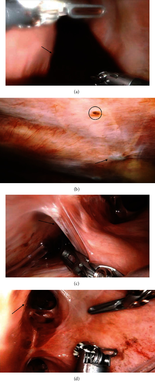 Robotic-Assisted Thoracic Surgery Approach to Thoracic Endometriosis Syndrome with Unilateral Diaphragmatic Palsy.