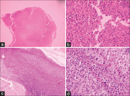 Pseudoepitheliomatous keratotic and micaceous balanitis: A distinct entity.