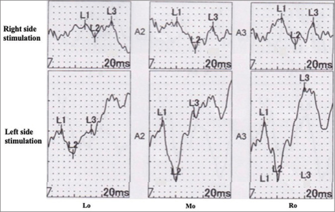 Visual-evoked potential predicts the efficacy of the optical canal decompression for traumatic optic nerve neuropathy showing blindness: A case report.