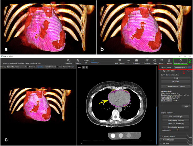 Artificial intelligence in cardiovascular imaging: enhancing image analysis and risk stratification.