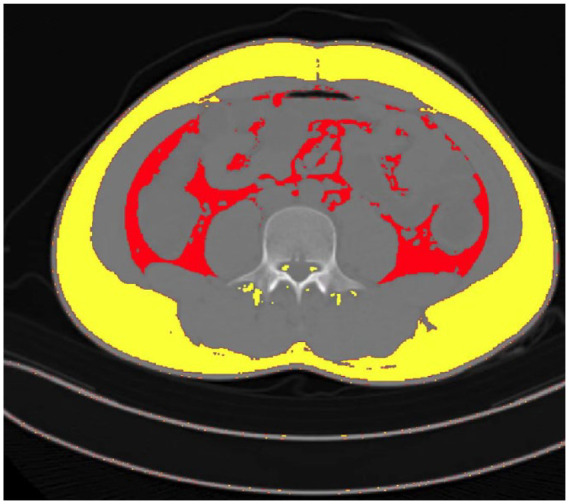 Effects of visceral adipose tissue on anti-tumour necrosis factor-α in Crohn's disease.