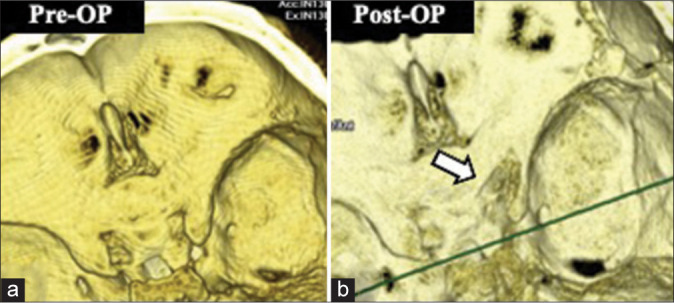 Visual-evoked potential predicts the efficacy of the optical canal decompression for traumatic optic nerve neuropathy showing blindness: A case report.