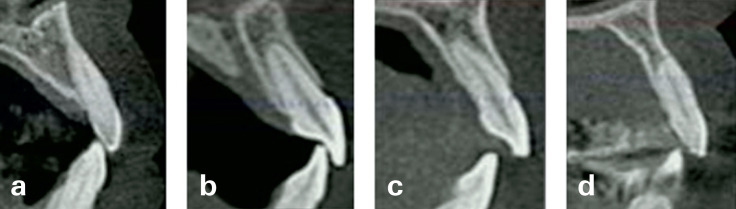 Single Immediate Implant Placement with Provisional Crown in the Esthetic Zone with 6 Years Follow-Up.