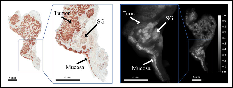 Fluorescence molecular optomic signatures improve identification of tumors in head and neck specimens.